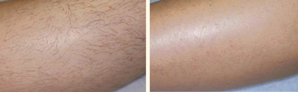 depilación ipl antes y después